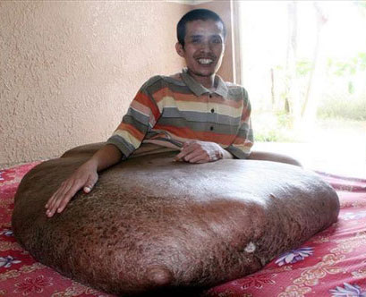 Человеку-слизняку удалили гигантскую опухоль весом 90 кг