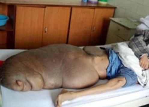 Человеку-слизняку удалили гигантскую опухоль весом 90 кг